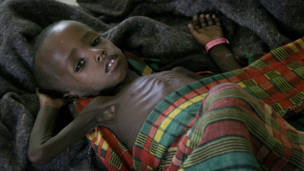 Dítě trpící podvýživou je léčeno na pediatrickém oddělení zdravotnického střediska Lékařů bez hranic v Hudduru. Podvýživa je endemická na mnoha místech v Somálsku.