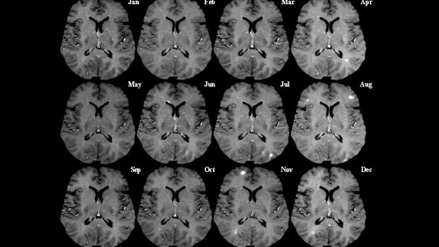 Snímky řezu mozku z magnetické rezonance v měsíčních intervalech. Světlé skvrny indikují aktivní poškození (léze)