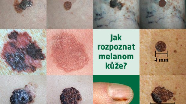 Jak rozpoznat melanom kůže? /koláž/