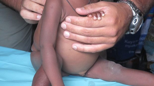 Humanitární mise v Malawi - Vyšetřování podvyživeného miminka