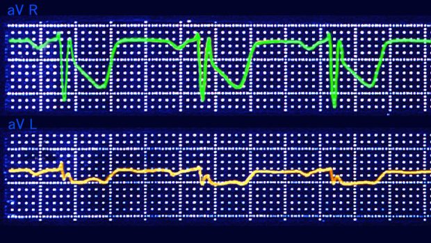 Elektrokardiogram znázorňující infarkt