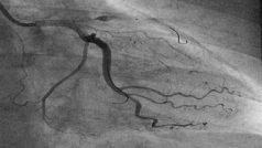 Céva srdečního svalu po úspěšné angioplastice