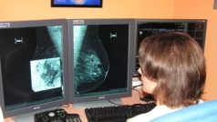 Digitální mamograf