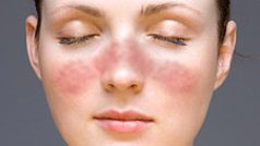 Typicky tvarovaná vyrážka na obličeji způsobená onemocněním lupus.