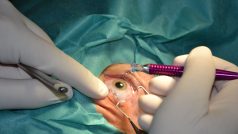 Lékaři v ústecké nemocnici mají jako první v Česku nový laser na operace zeleného zákalu