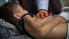 Čtyřletý Zakaria, který se léčí s podvýživou v nemocnici v afghánské provincii Kandahár