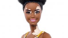 Panenka Barbie s kožním onemocněním vitiligo
