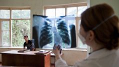 Tuberkulóza: lékařka v centru pro infekční choroby, AIDS a tuberkulózu v gruzínském Batumi prohlíží rentgenový snímek.