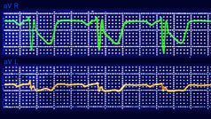 Elektrokardiogram znázorňující infarkt