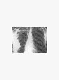 tuberkulóza
