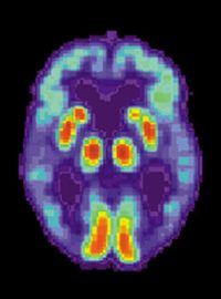 Mozek pacienta trpícího Alzheimerovou chorobou - snímek pořízený pozitronovou emisní tomografií (PET)