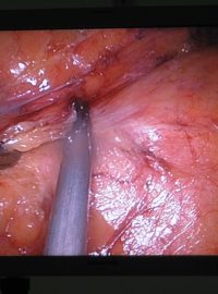 Vystříhávání ledviny z tuku při operaci v nemocnici v Příbrami