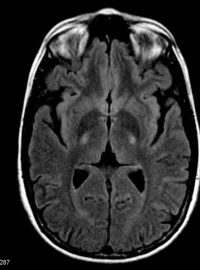 Mozek pacienta trpícího amyotrofickou laterální sklerózou na snímku z magnetické rezonance