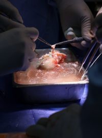 Pacient v USA dostal upravenou prasečí ledvinu