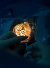 Detail operace, která proběhla na oftalmologickém sálu bejrútské nemocnice Rafic Hariri University Hospital.
